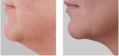 exilis chin