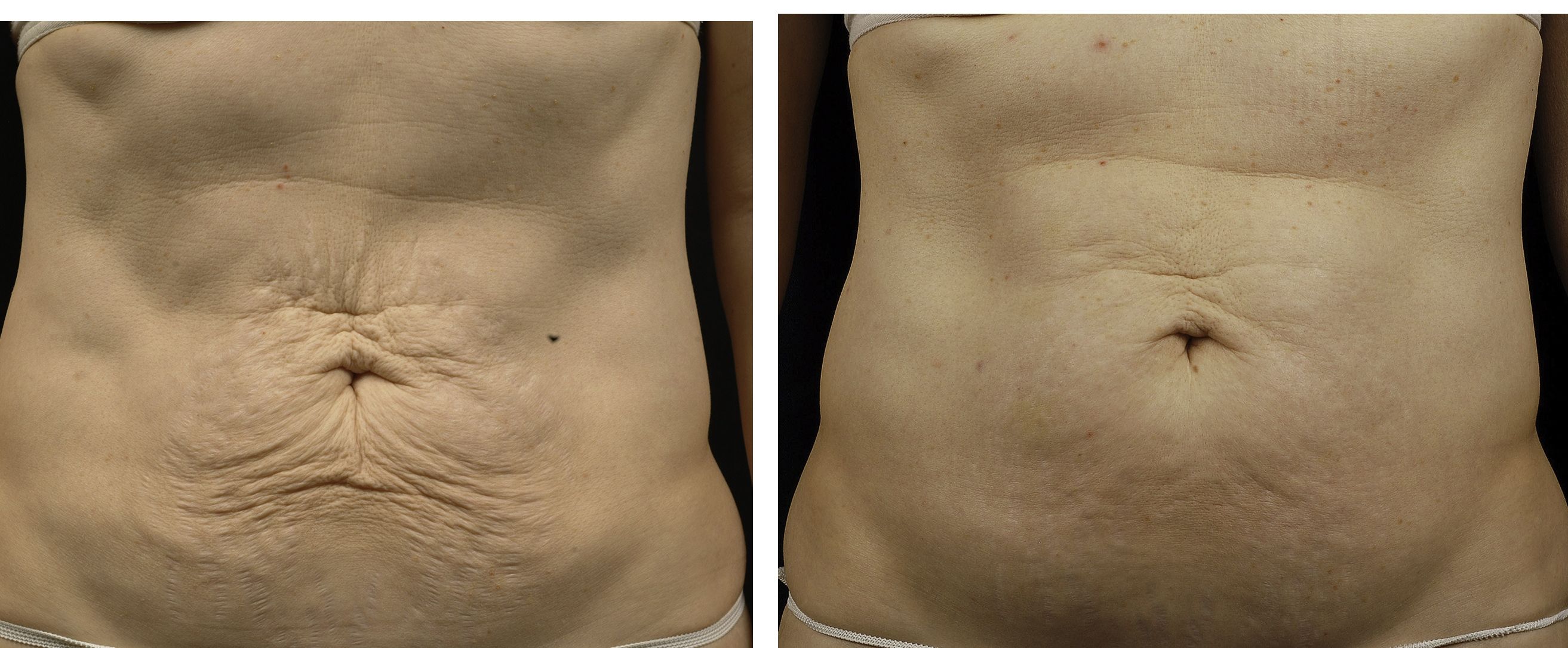 Tummy Treatment by Richard Asarch, MD. Pre and 6 months post.