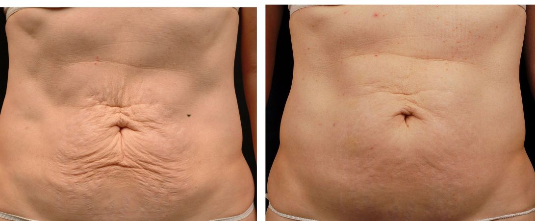 Tummy Treatment by Richard Asarch, MD. Pre and 6 months post.