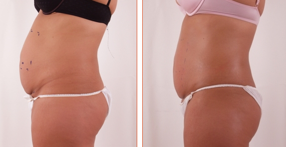 Exilis Before and After Tummy