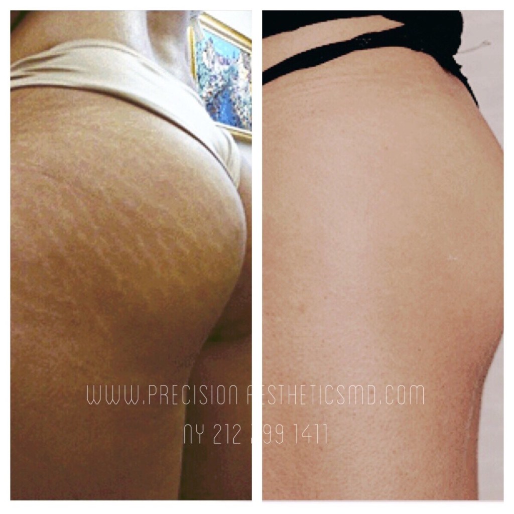 Stretch mark reduction&nbsp;treatment