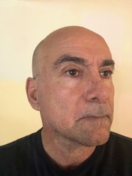 Thermage Face Male jaw line