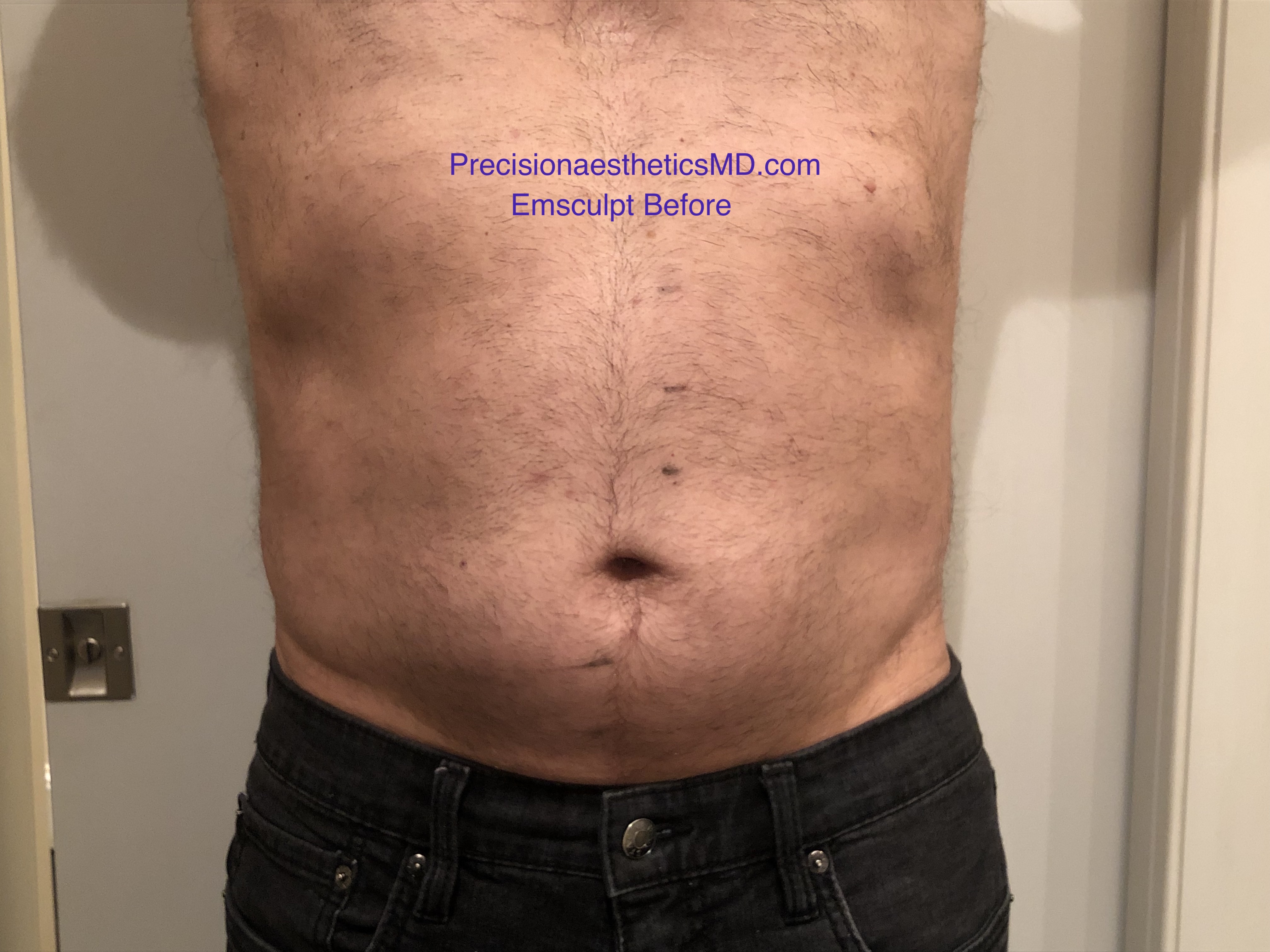 Emsculpt Before W