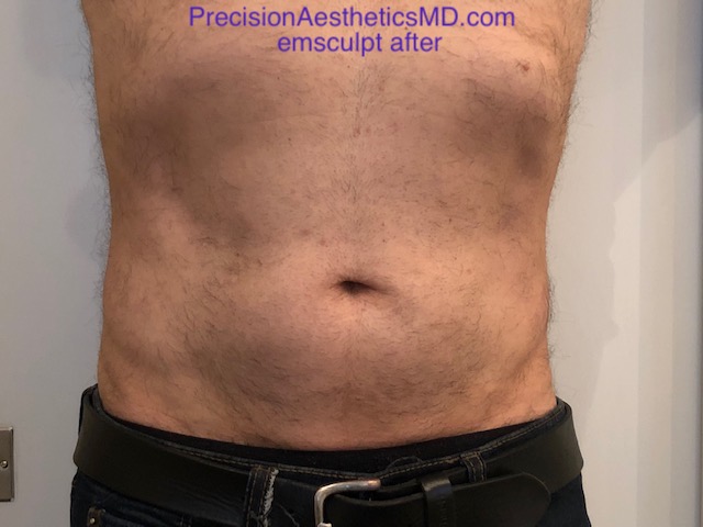 Emsculpt after