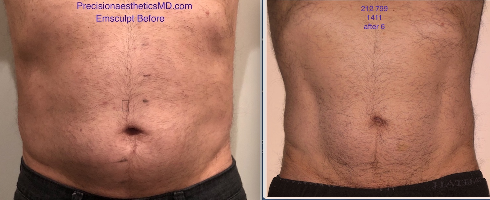 Six Pack Abs ( my answer on quora)