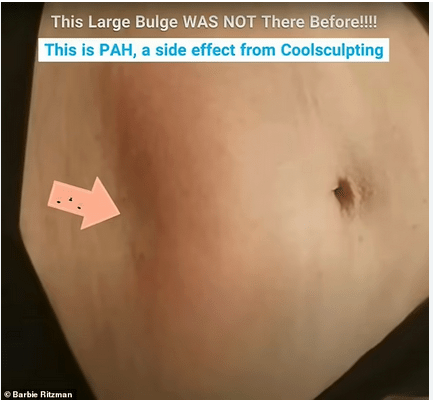 Coolsculpting vs Emsculpt