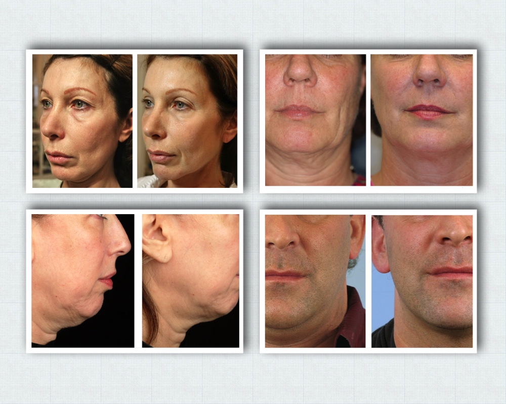 Achieve Youthful Skin with Thermage: FAQs &&nbsp;Benefits